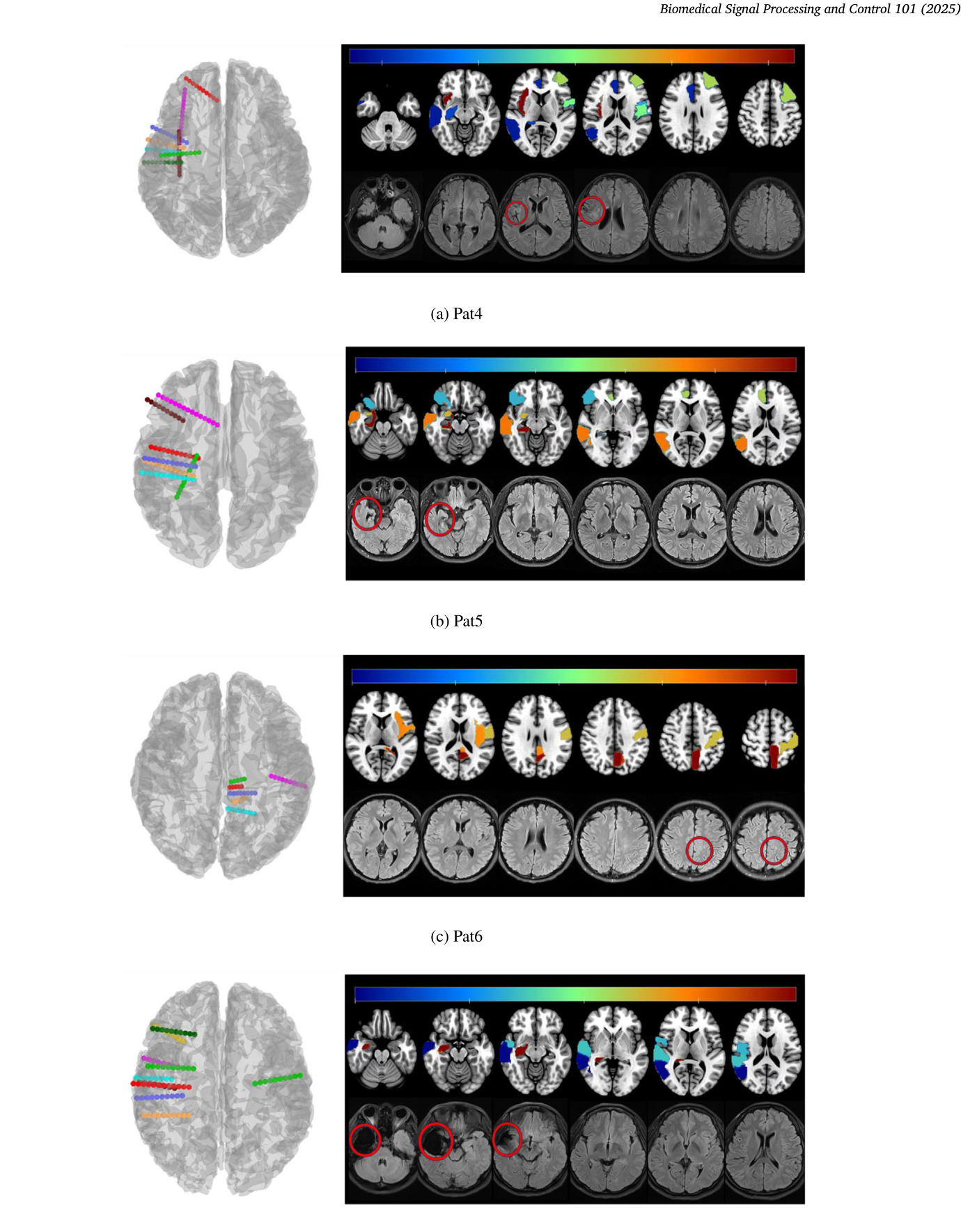 术后 MRI 对照