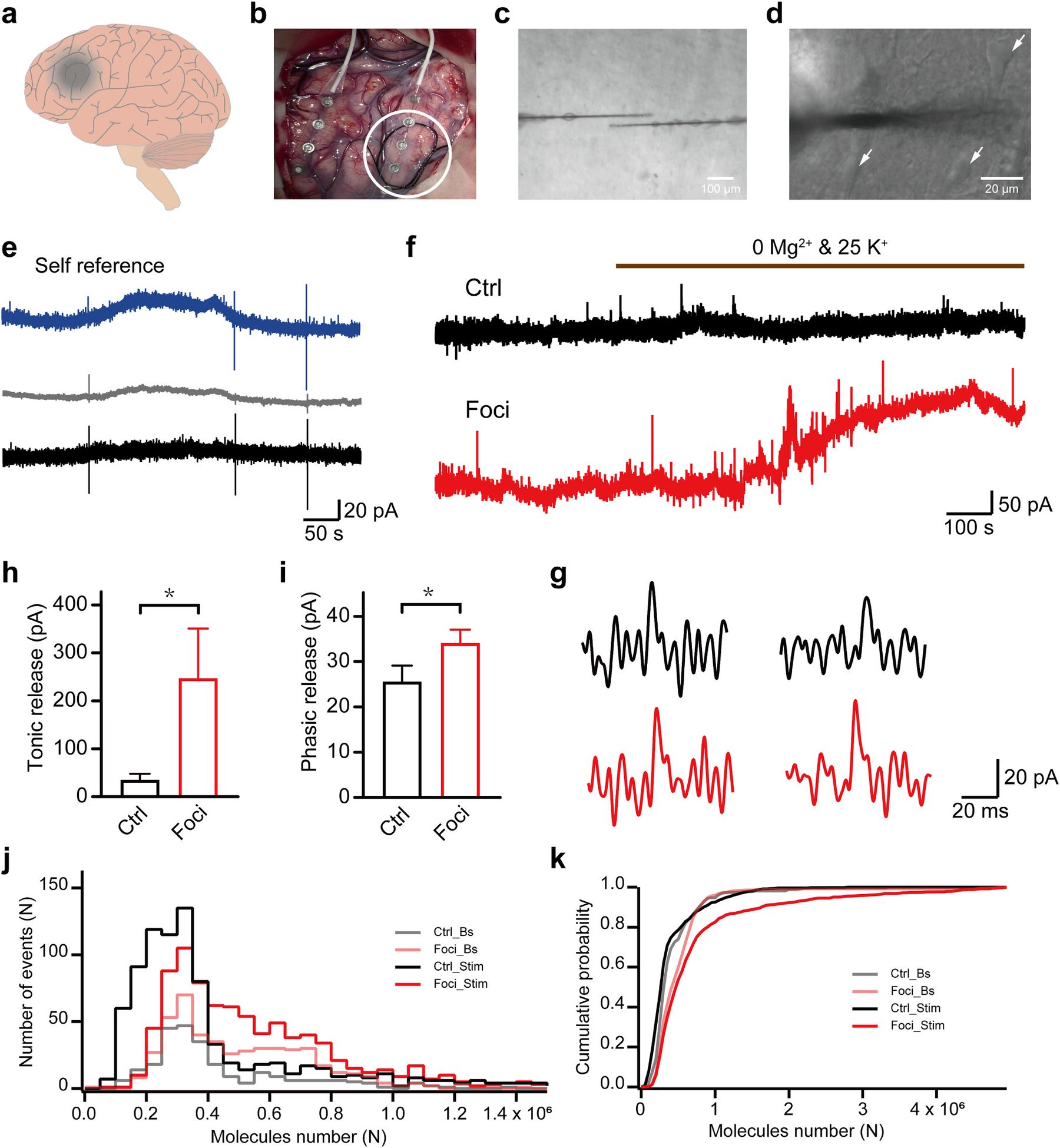 Zhao 等 2026 原文 Figure 3：人体 FCD 癫痫灶中的 tonic 和 phasic glutamate release
