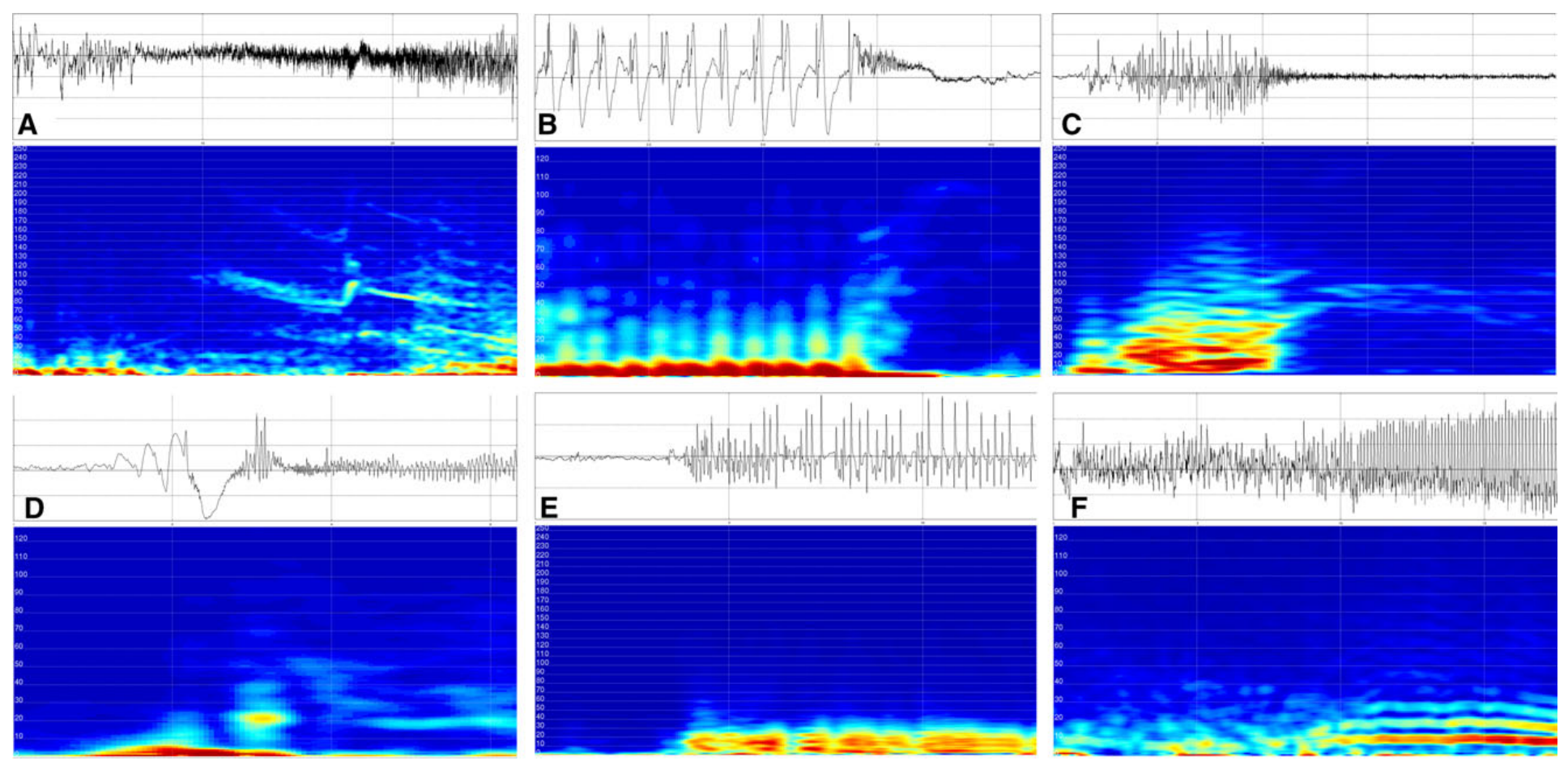 Lagarde 2016 Figure 2：六种 SEEG seizure-onset pattern