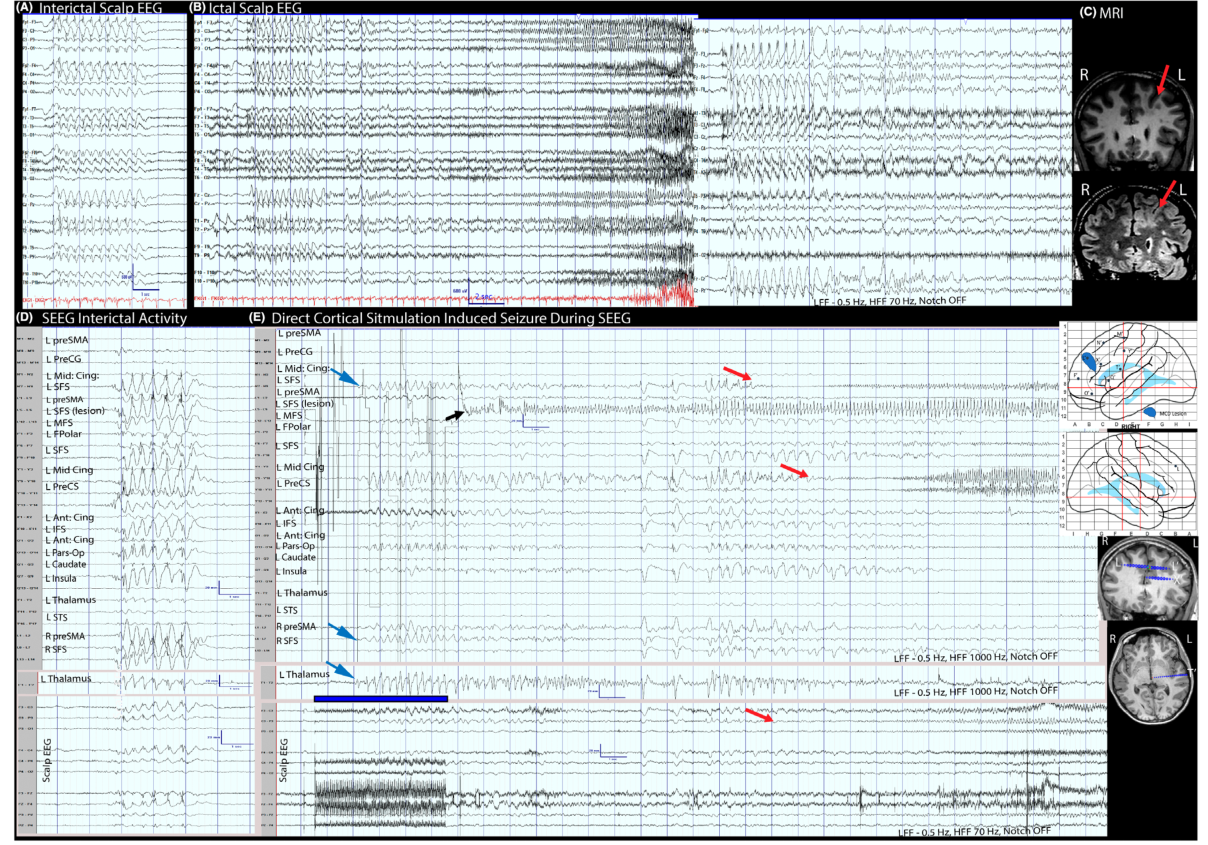 Aung 2026 Figure 1：Phase I 与同步 SEEG-EEG 结果